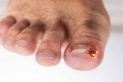Ingrown nails pain