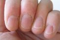 Brittle nails: how to treat them?