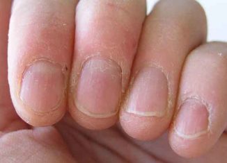 Brittle nails: how to treat them?