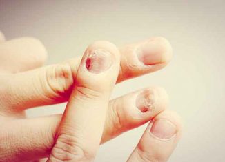 False nails and mycosis: choose your nail stylist well