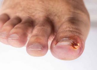 Ingrown nails pain