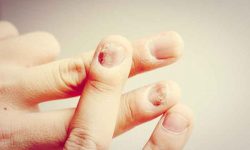 False nails and mycosis: choose your nail stylist well