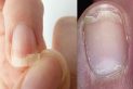 Effective treatments against splitting nails