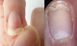 Effective treatments against splitting nails