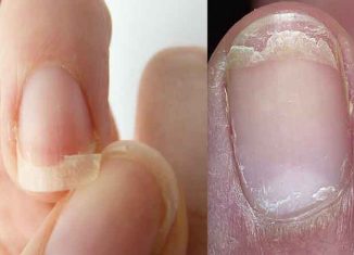 Effective treatments against splitting nails